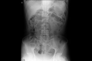腹部のレントゲン写真画像