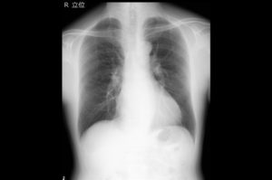 胸部のレントゲン写真画像
